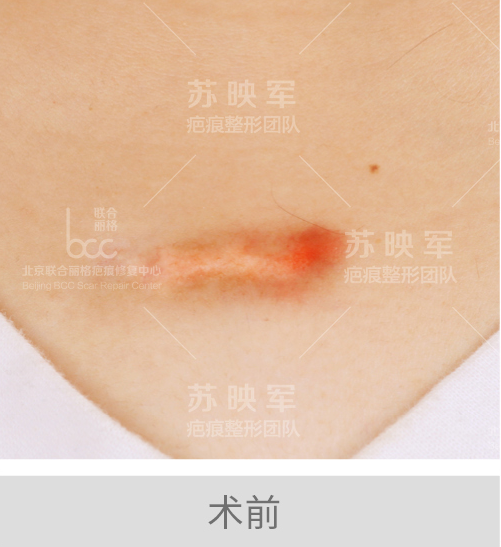 挤痘竟然挤出一个肉疙瘩,抗痘战争真不能乱来