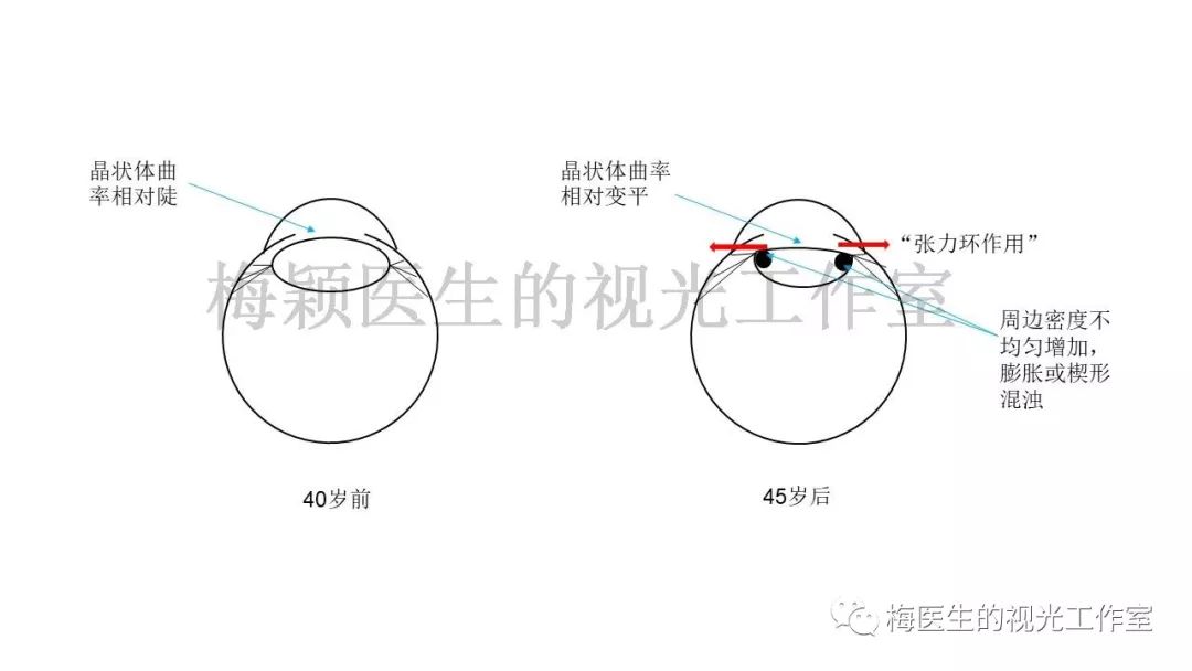 goss;近距内隐斜(roberts and banford,goss;颞侧近视弧斑和近视性