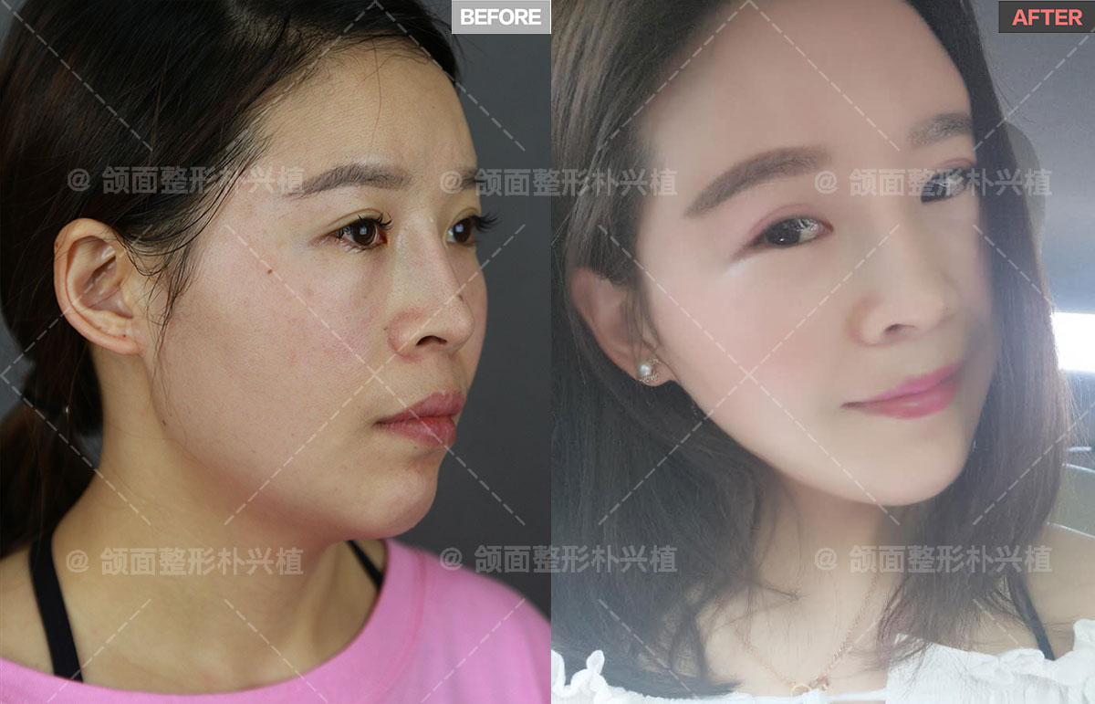 上海首尔丽格医疗美容医院-整形美容科-住院医师朴兴植   aso凸嘴