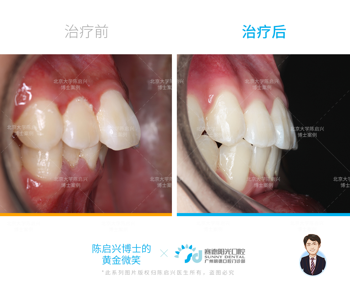 腺样体面容 兔牙 深覆盖矫正案例