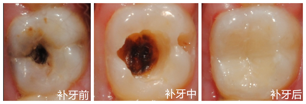 牙齿咬合面黑线,大牙一般最常见,说明开始蛀牙了,牙釉质被细菌龋坏,但