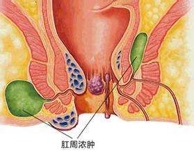 肛门坠胀这种症状是很多肛肠疾病患者会出现的,但很多时候没有引起