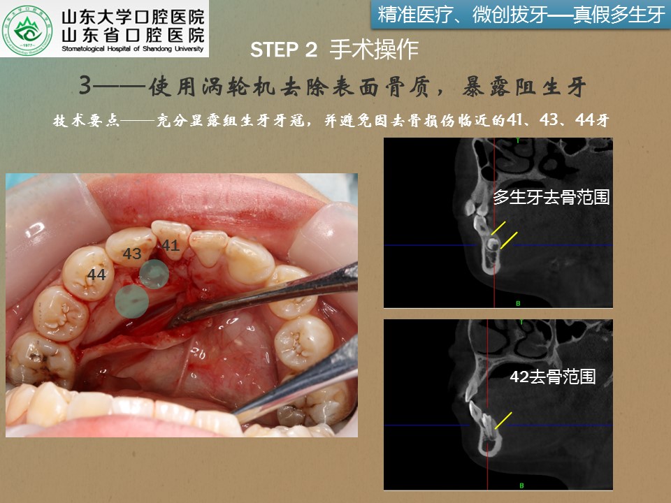 疑难复杂牙拔除系列3右下颌前磨牙根方两颗多生牙