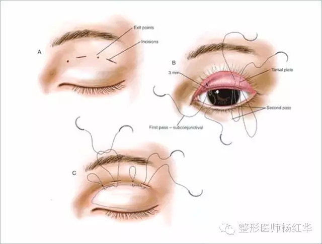 当开学季遇上双眼皮各种高科技双眼皮手术到底神奇在哪里