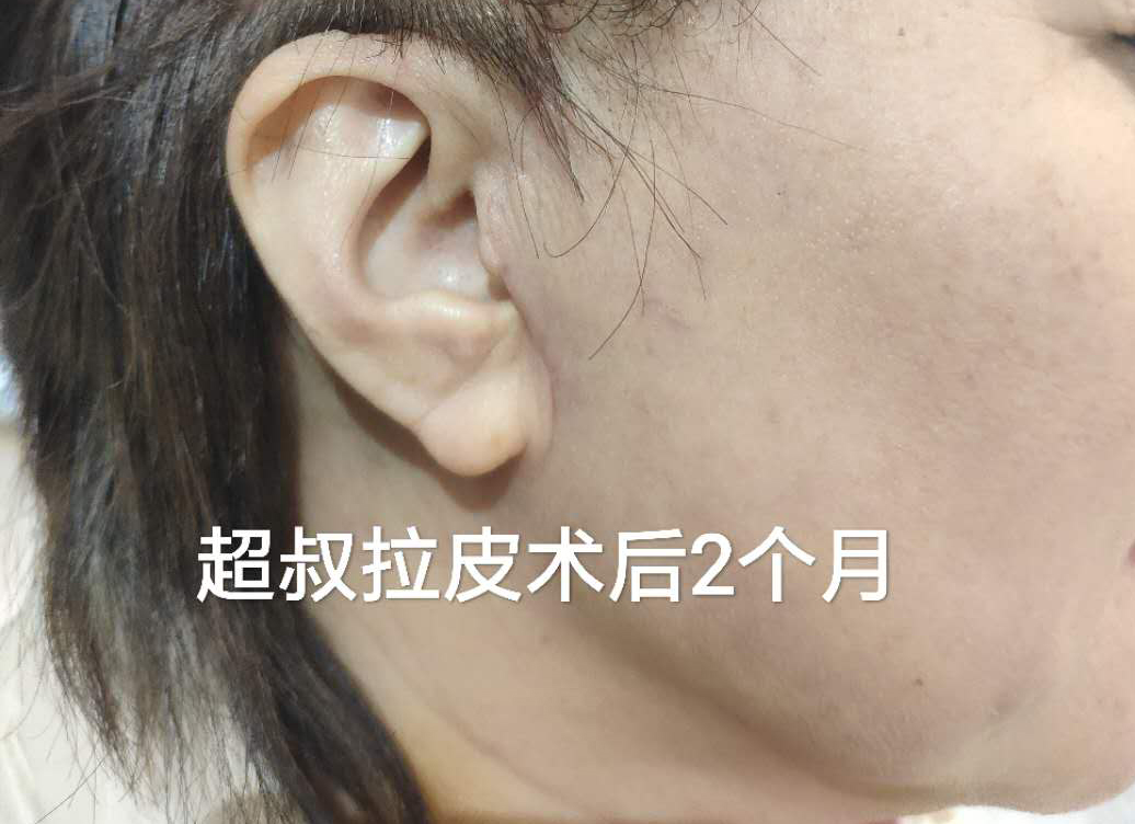 现在做拉皮手术一般都采用减张精细缝合,从而最大限度的降低了疤痕的
