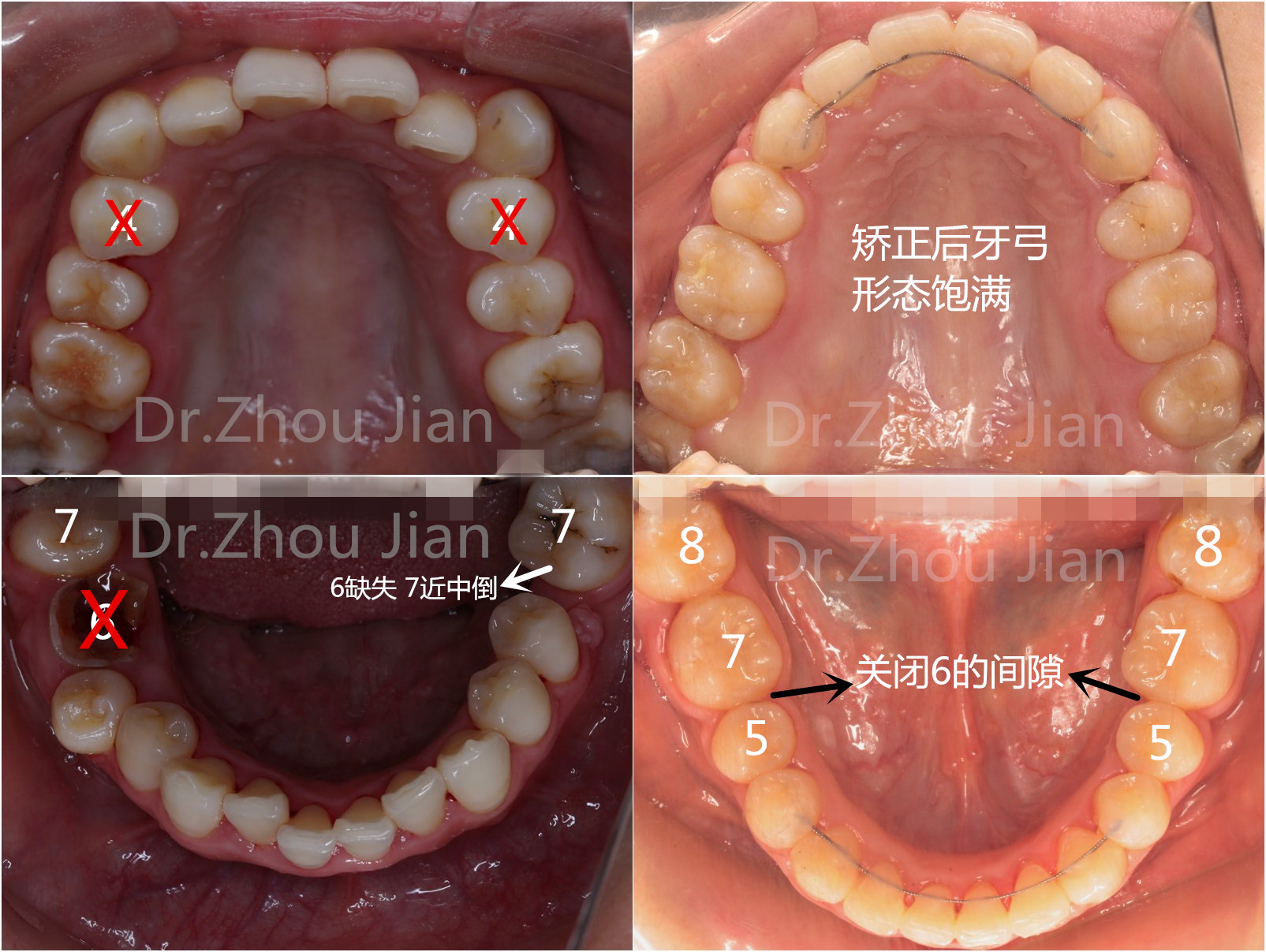 这位客人下颌6号牙齿残缺十几年,后面的7号磨牙也完全躺倒,智齿还没有