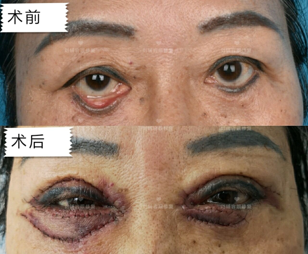 手术也不该被轻视 双眼眼袋去除与中面部线雕术后半年,导致双下睑外翻
