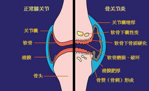 膝关节炎的表现症状有哪些