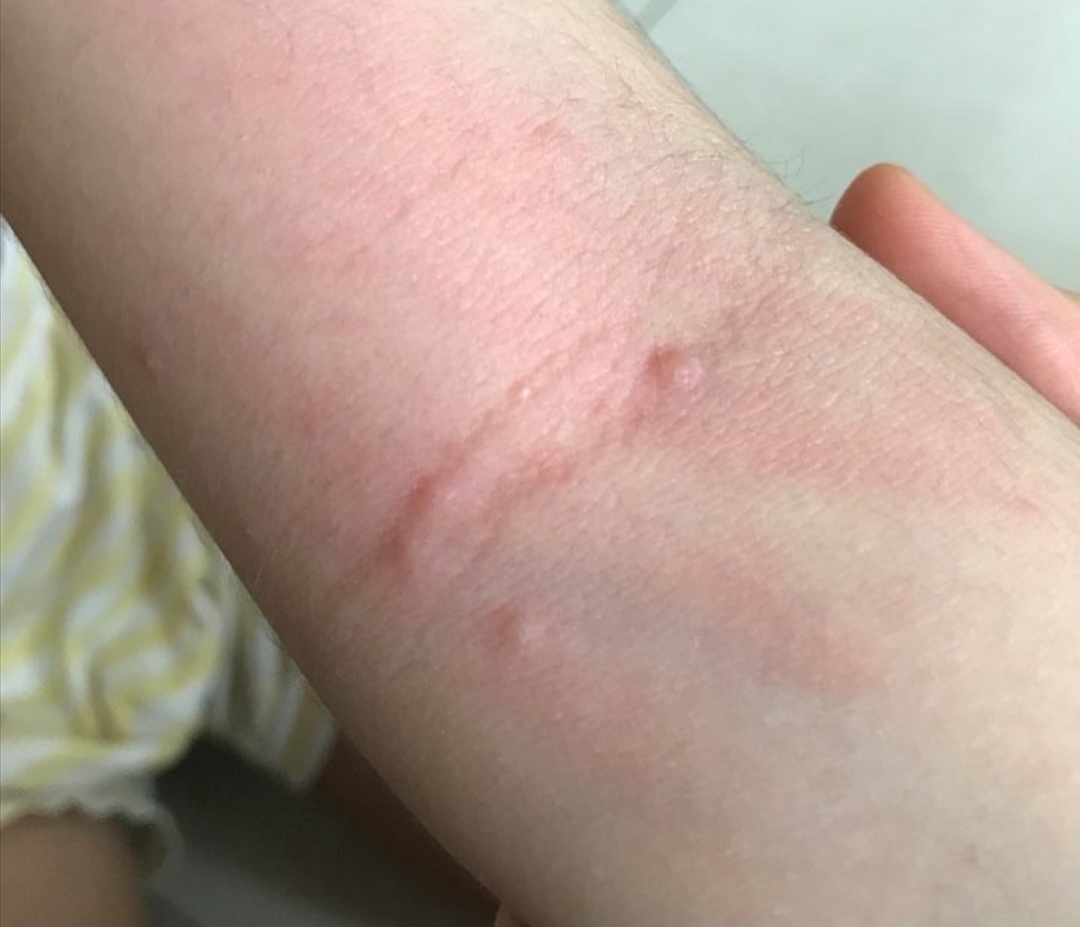 急性痒疹好发于 儿童, 夏季多见.