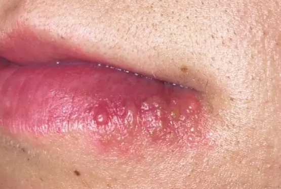 是什么引发的口唇疱疹?