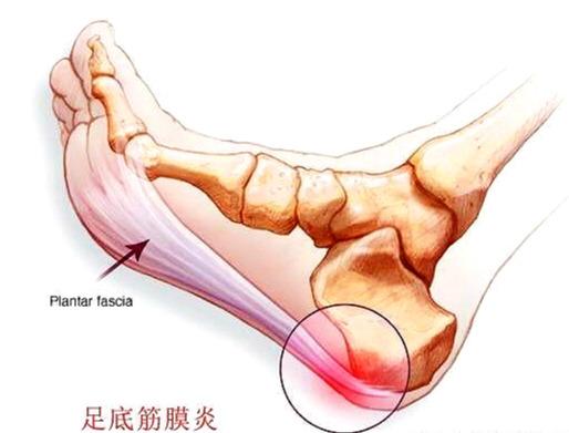 脚底板疼,早上起来不敢脚落地!这是啥问题,该咋办?医生告诉您