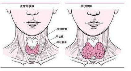 关于甲状腺结节最常见的5个问题