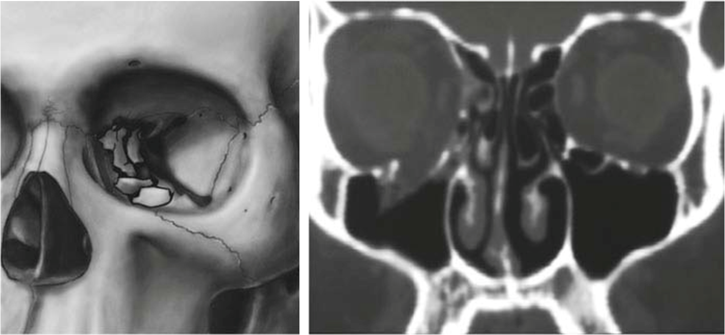 爆裂性眼眶骨折及类型眼眶骨折那些事儿