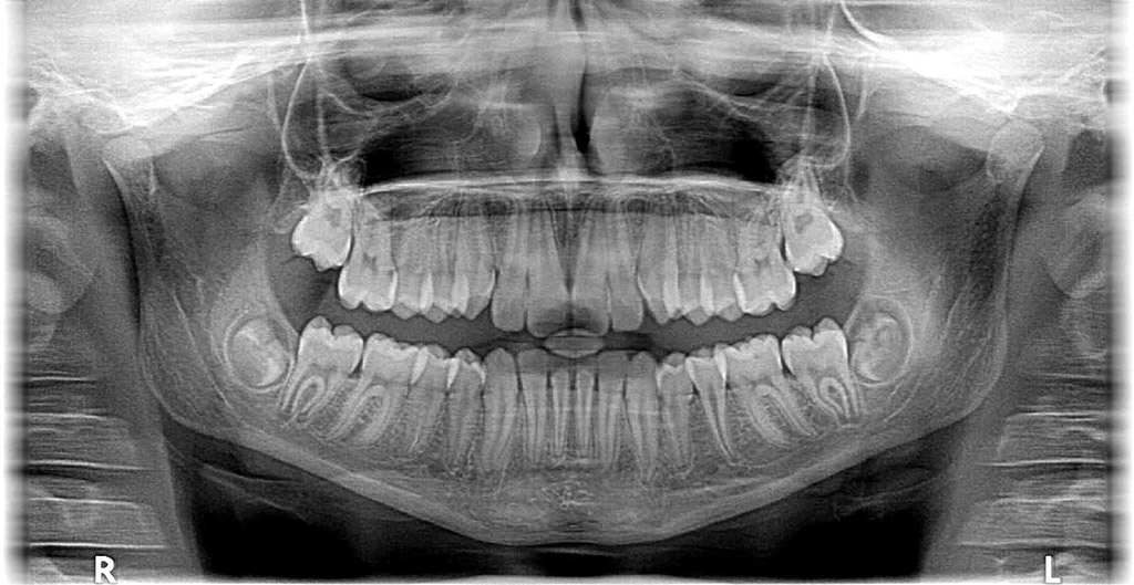侧位的x光片可以告诉我们上下颚骨的相对的关系,牙齿的走向,判断暴牙