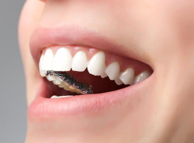 成人牙齿矫正:这些牙齿矫正方法的优缺点你知道吗?