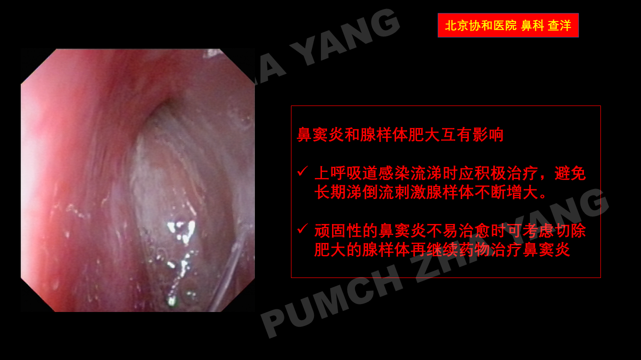 腺样体肥大程度的判断方法