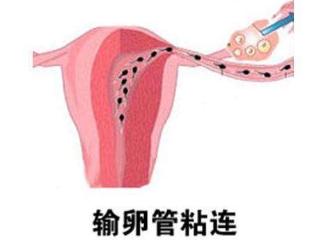 宫腔粘连要怎么解决