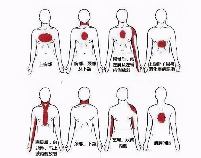 心肌梗死的报警:心绞痛!这时候就诊,能避免心肌梗死!