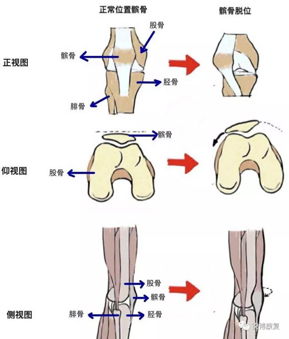 股骨滑车沟为它提供了骨性支持,周围的肌肉和韧带则为它的运