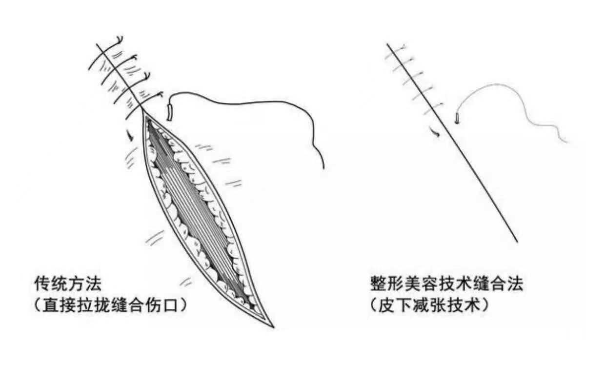 超减张精细缝合术的由来