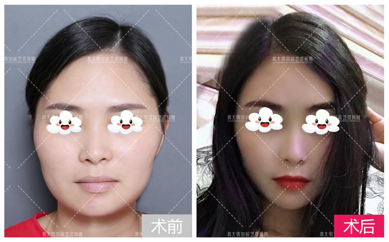 作为东方人,由于我们的面部普遍比较扁平,立体感不强,因此颧骨突出不