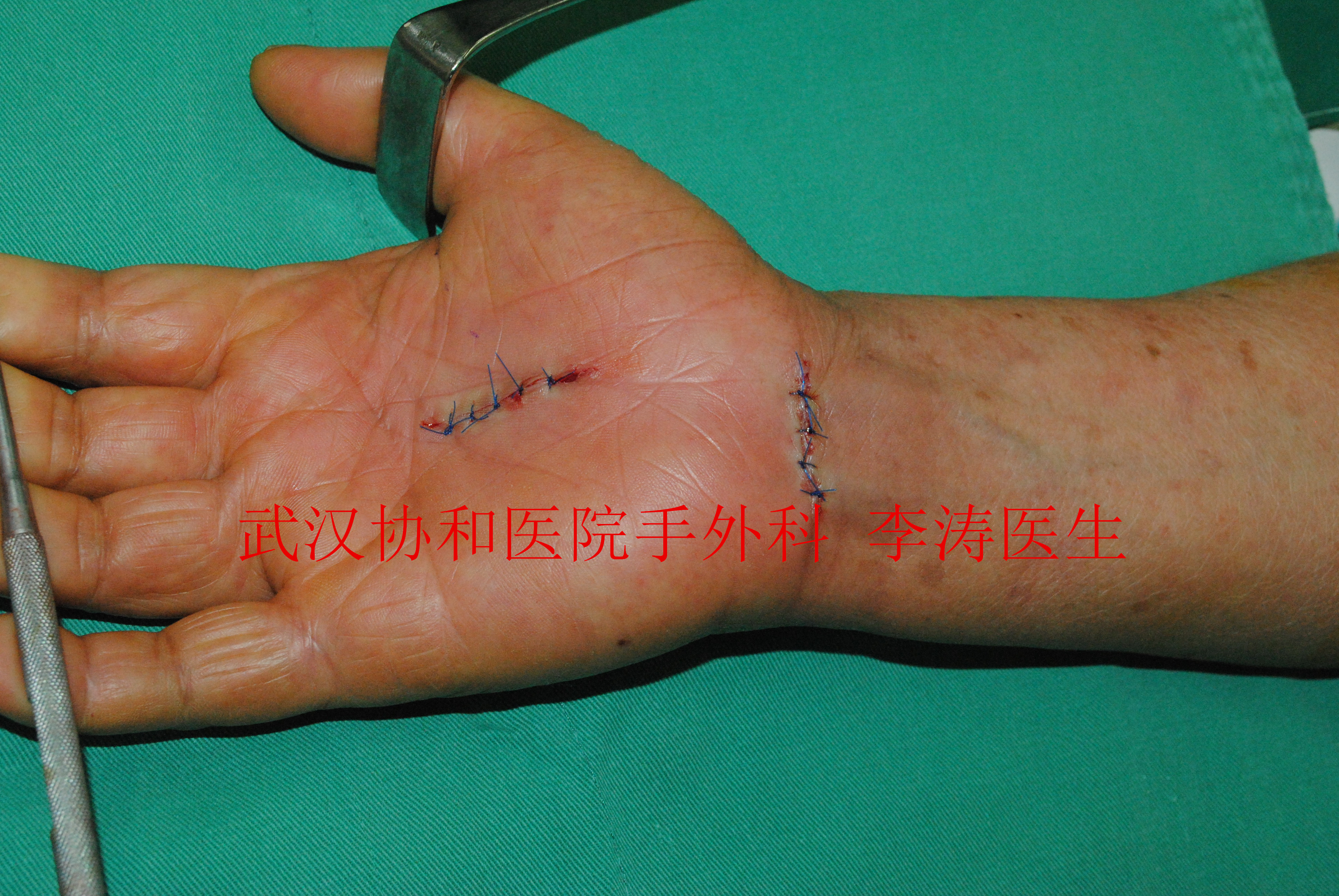腕管综合征手术后复发的再次手术治疗