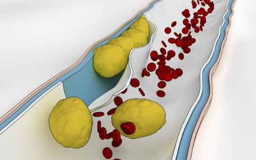 脂蛋白a高是怎么回事?对心脑血管有何危害?医生为你讲出实情