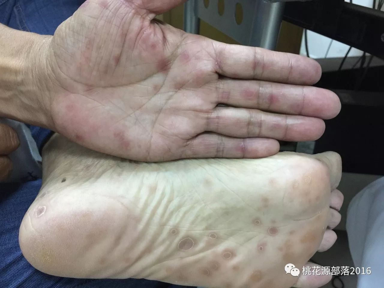 长在手掌,足掌的二期梅毒疹,发生在躯干时,易被误诊为玫瑰糠疹
