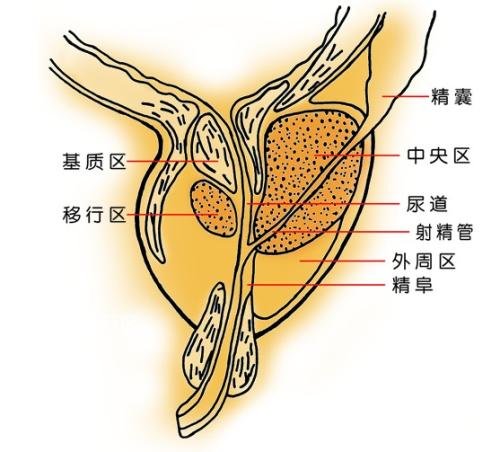 前列腺炎