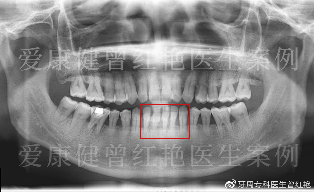 治疗前x片显示牙槽骨吸收约根长2/3