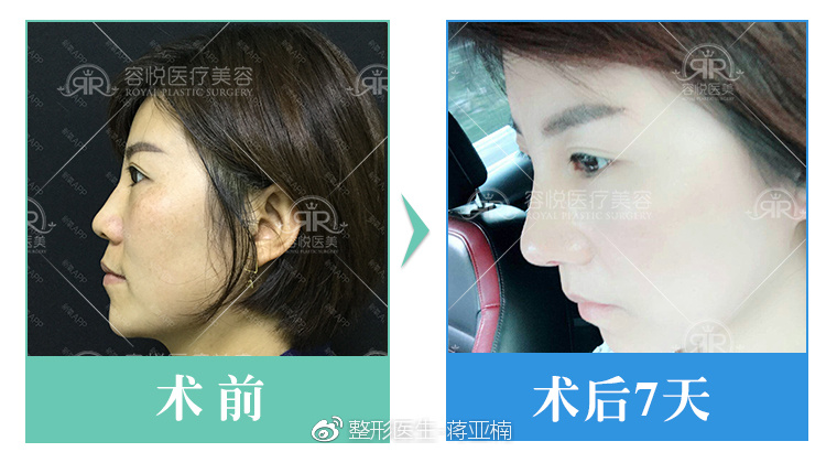 隆鼻整形防忽悠,耳软骨,鼻中隔软骨,肋软骨,你适合什么术式?