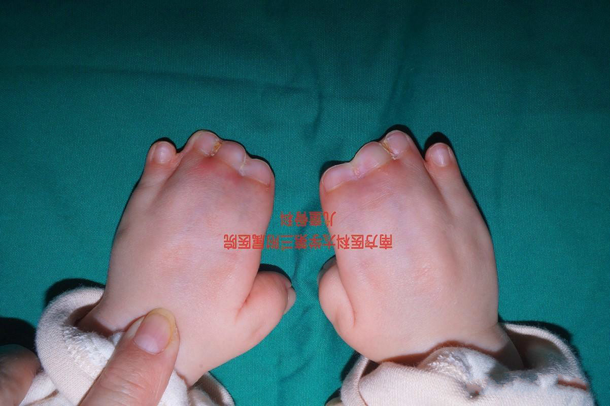 大龄宝妈图省钱不做产检,新生宝宝手足并指畸形!早发现早治疗!