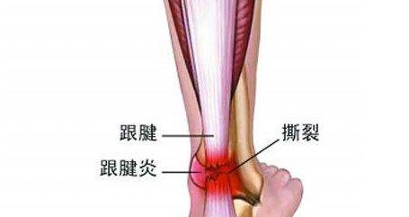 某篮球巨星跟腱受伤,日常运动中学会先保护自己