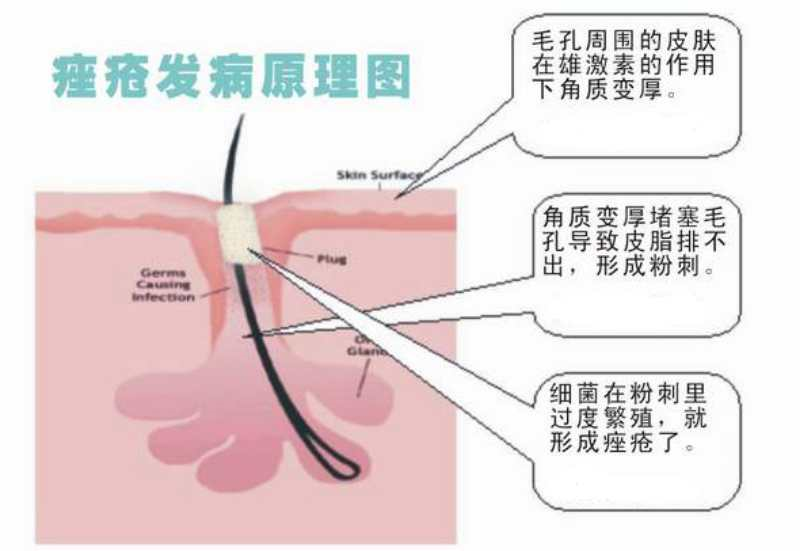 毛囊皮脂腺导管堵塞 毛囊皮脂腺导管的角化异常会造成导管堵塞,皮脂
