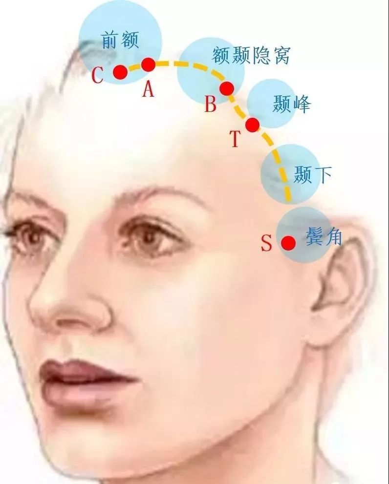 按照5a5p发际线设计法,将发际线前额,额颞隐窝,颞峰,颞下和鬓角等5