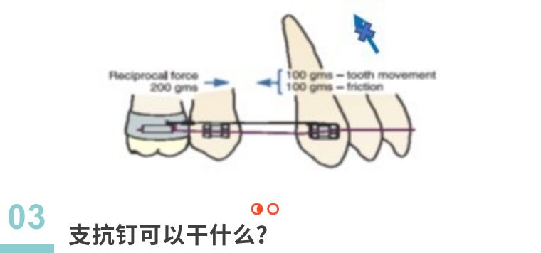 矫正牙齿为什么需要使用支抗钉?