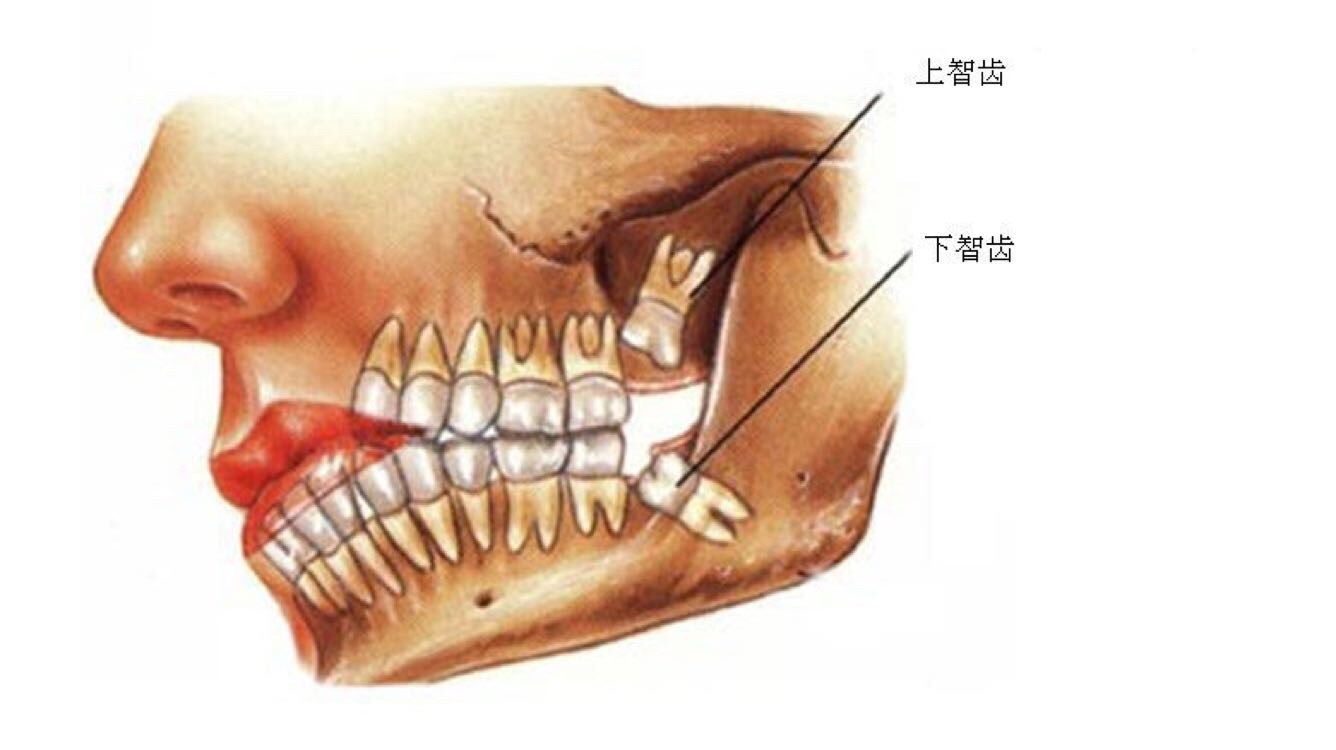 智齿是指人类口腔内牙槽骨上最里面的第三颗磨牙,从正中的门牙往里面