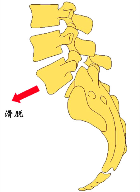 腰椎滑脱危害大四症状提示病情严重