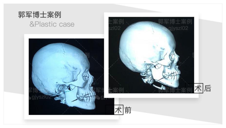 但是,锥形束ct对面部骨骼轮廓的重塑,比较粗糙,不具有诊断价值,且与