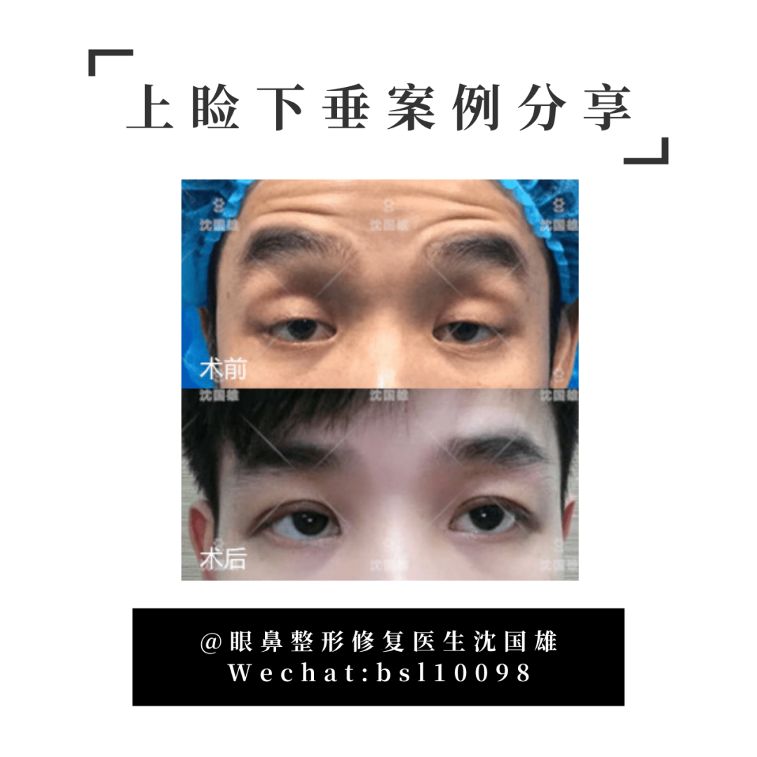 上睑下垂危害有哪些?该如何改善?