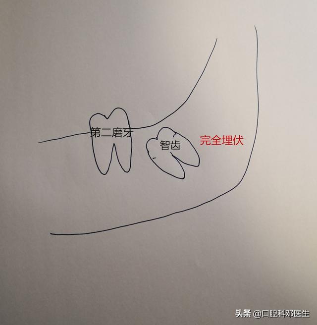 告诉大家一个好消息,你的智齿可以不拔啦!你拔了吗?