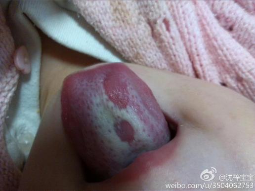 二十个月,舌头这样有四五个月了,您看看这是什么呀?