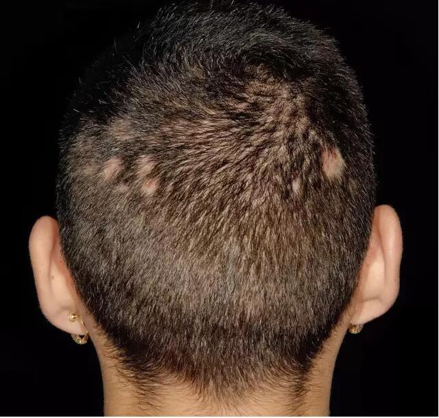 早期的头部穿掘性毛囊炎,容易与其他深在性毛囊炎及其他瘢痕性脱发