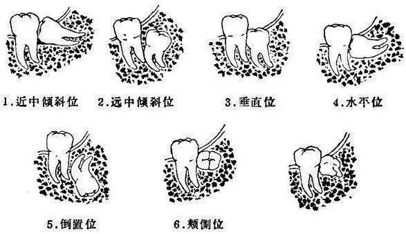 你的智齿需要拔吗?纠结100回不如看一遍(下续)