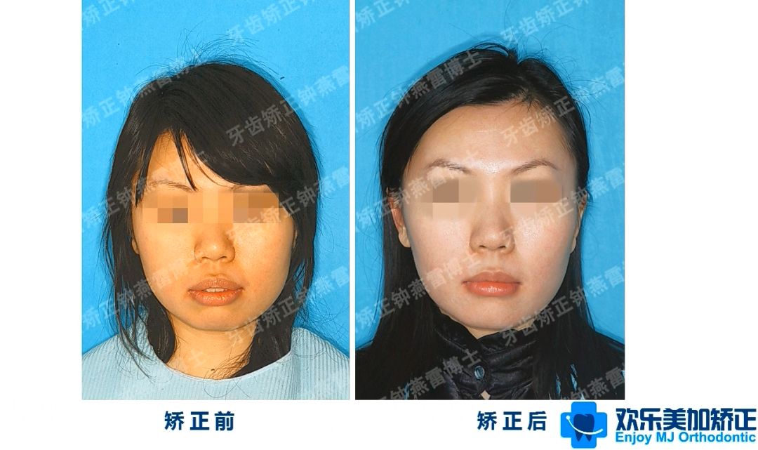 治疗前她上颌前突,下颌后缩,通过拔牙矫治,牙齿往回收,解决了上颌前凸