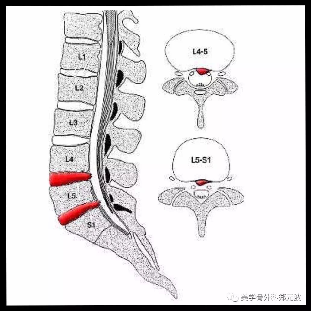 腰椎间盘突出症以腰4～5,腰5-骶1发病率最高,约占95.