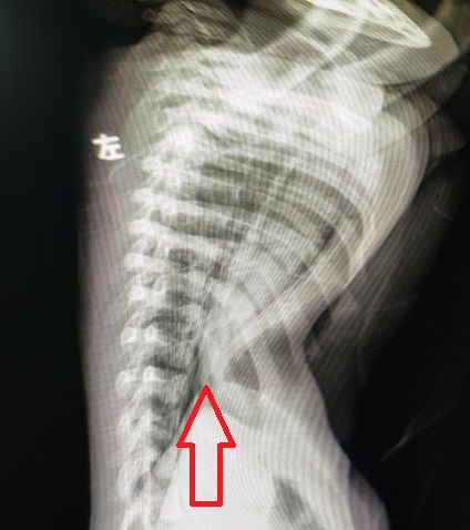 2岁漏斗胸wang手术:"前胸贴后背",极其严重