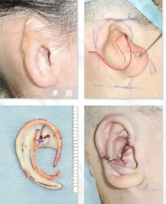 一般来说,耳再造手术,不管是耳再造一期耳廓成形术,还是耳再造二期耳