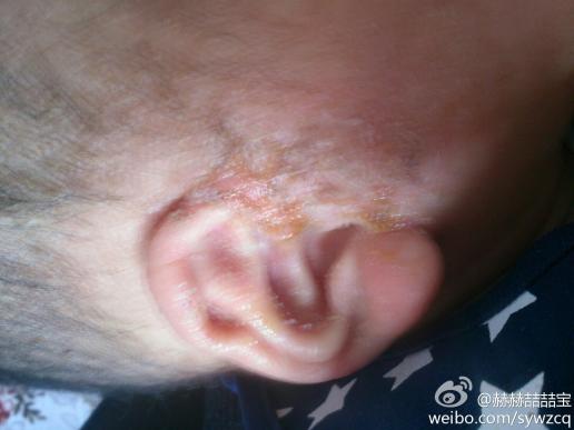严重流水,已用过肤乐霜和艾洛松,效果不明显,总反复,宝宝已六个月