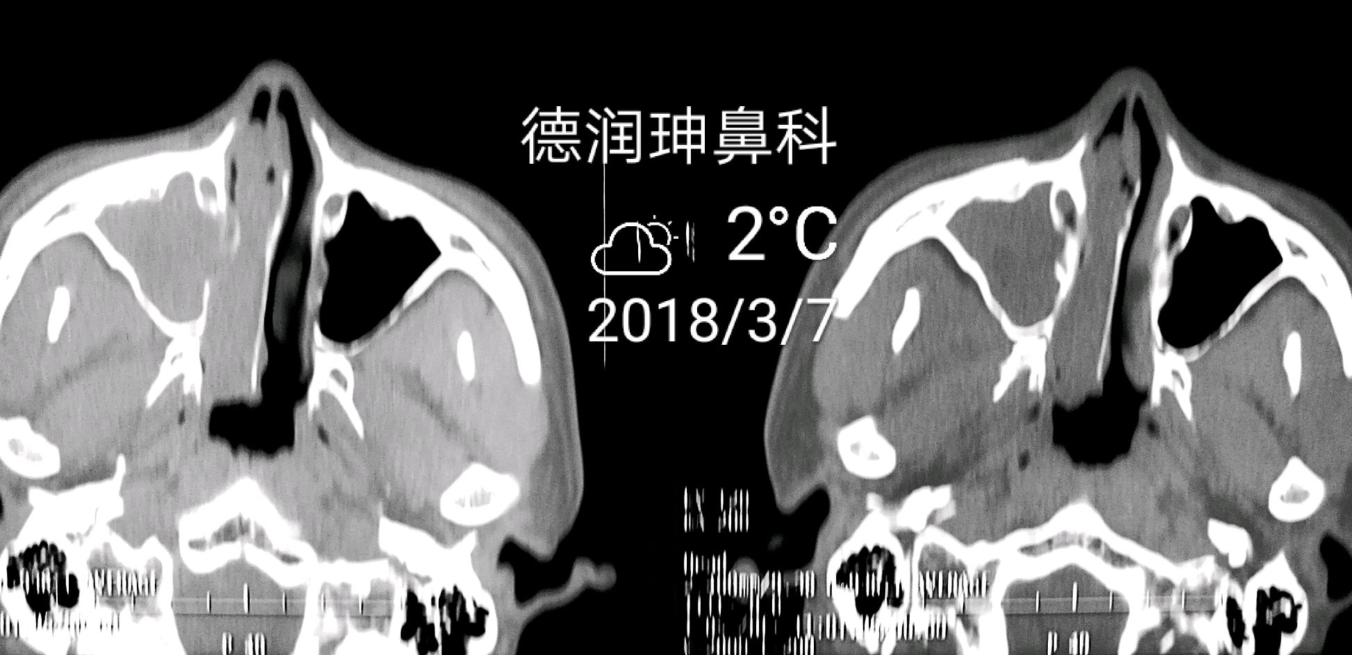 内翻性乳头状瘤一例